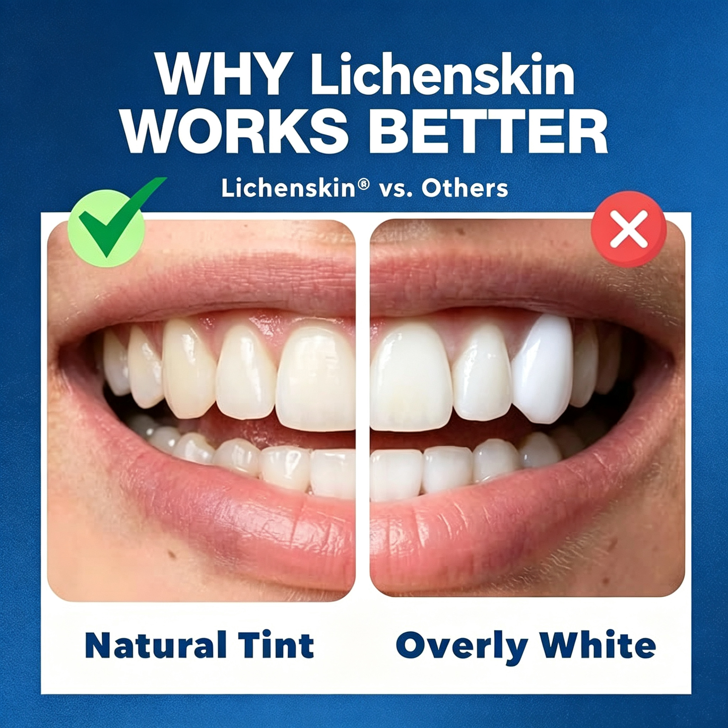 Lichenskin® Tooth Tinted Plastic - Natural Color - Temporary Tooth - Made in USA