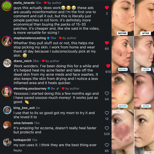 Lichenskin™ Hydrocolloid Acne Patches – The Easy Fix For Breakouts