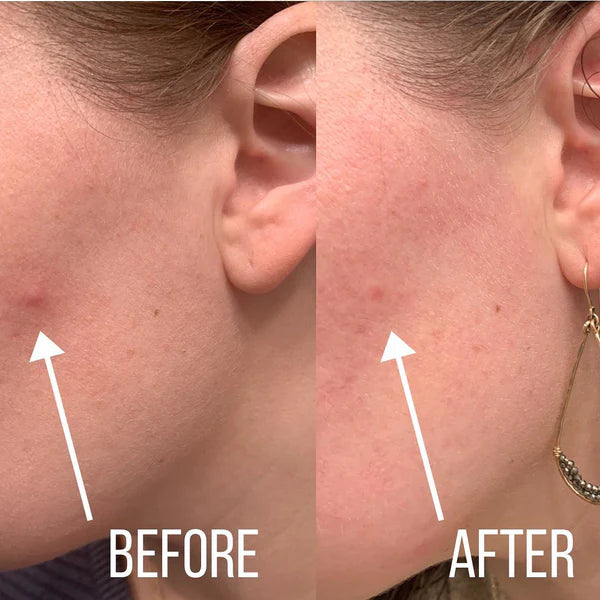 Lichenskin™ Hydrocolloid Acne Patches – The Easy Fix For Breakouts