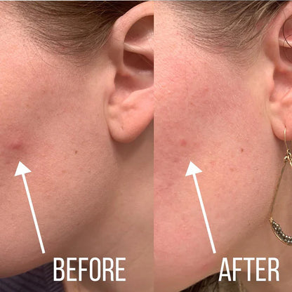 Lichenskin™ Hydrocolloid Acne Patches – The Easy Fix For Breakouts