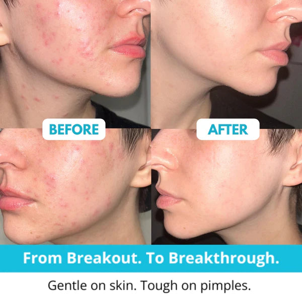 Lichenskin™ Hydrocolloid Acne Patches – The Easy Fix For Breakouts