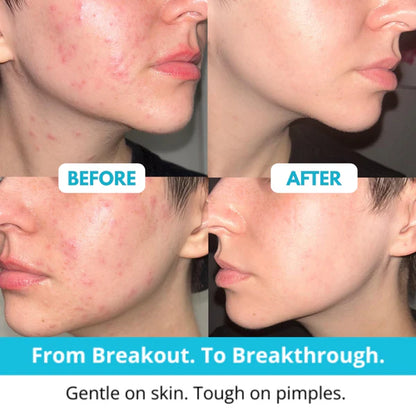 Lichenskin™ Hydrocolloid Acne Patches – The Easy Fix For Breakouts