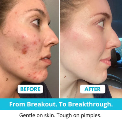 Lichenskin™ Hydrocolloid Acne Patches – The Easy Fix For Breakouts