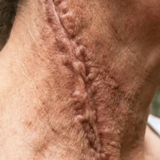 Real Healing Doesn't Require Expensive Appointments Lichenskin® Scar Repair Cream