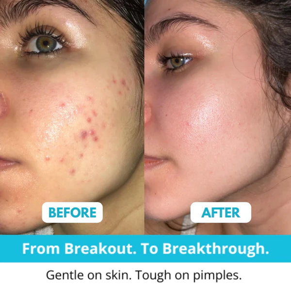 Lichenskin™ Hydrocolloid Acne Patches – The Easy Fix For Breakouts
