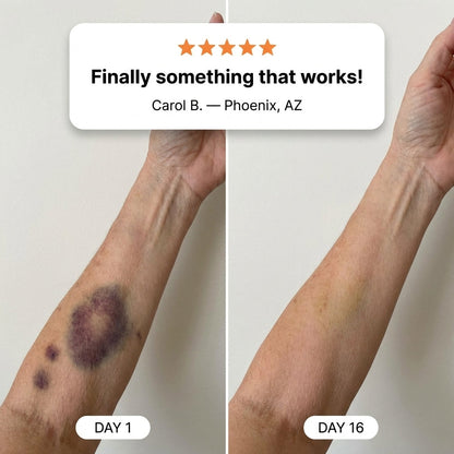 💥100K+ SOLD💕- Lichenskin® Bruise Repair & Skin-Strengthening Cream